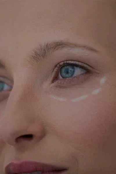 Trusted Blepharoplasty Service in Quezon City