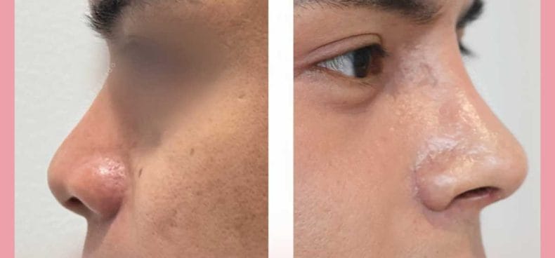 Understanding Rhinoplasty