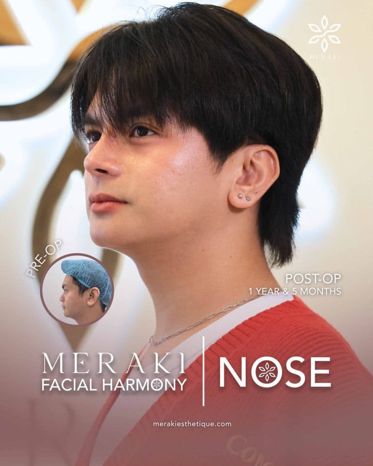 Vin for Meraki Nose
