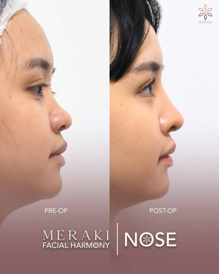 Before and After Rhinoplasty Philippines 5