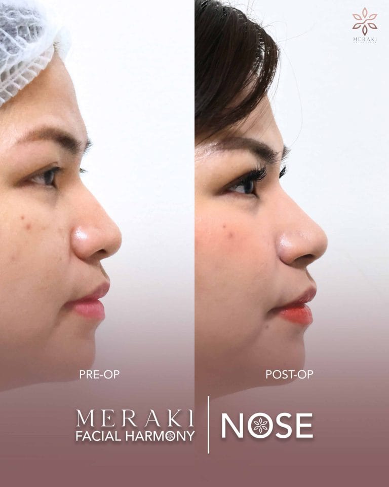 Before and After Rhinoplasty Philippines 4