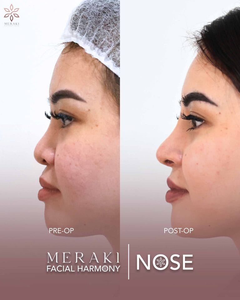 Before and After Rhinoplasty Philippines 3