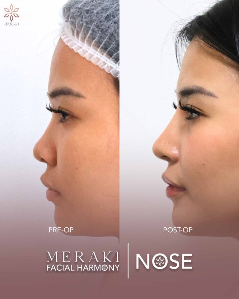 Before and After Rhinoplasty Philippines 2