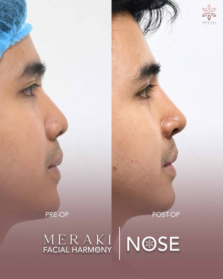 Before and After Rhinoplasty Philippines 1