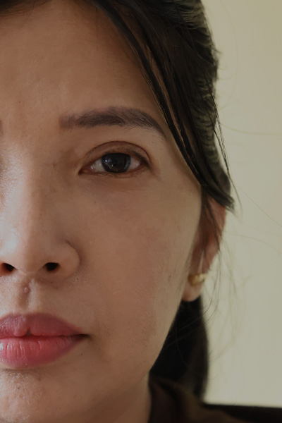 Trusted Blepharoplasty Service in Quezon City