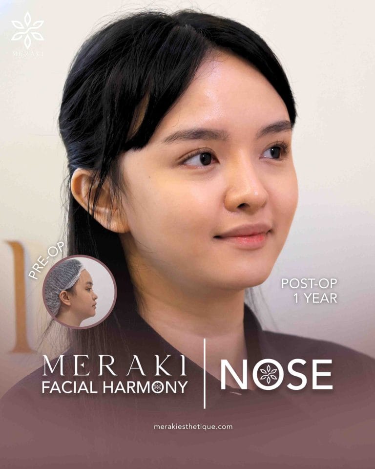 Best Rhinoplasty in Philippines