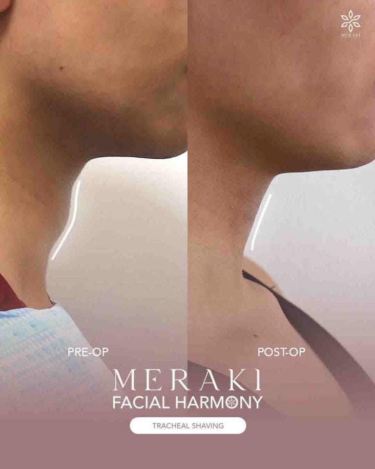 Best Tracheal Shaving in Philippines