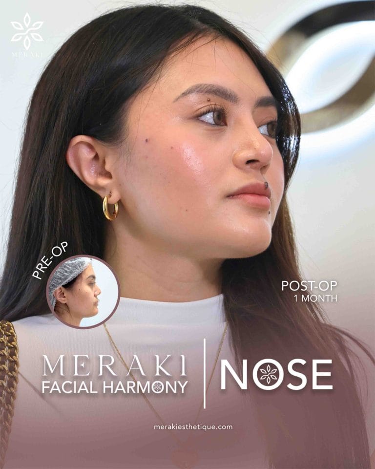 Trusted Rhinoplasty in Philippines