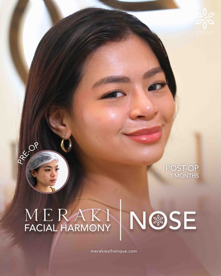 Trusted Rhinoplasty in Philippines
