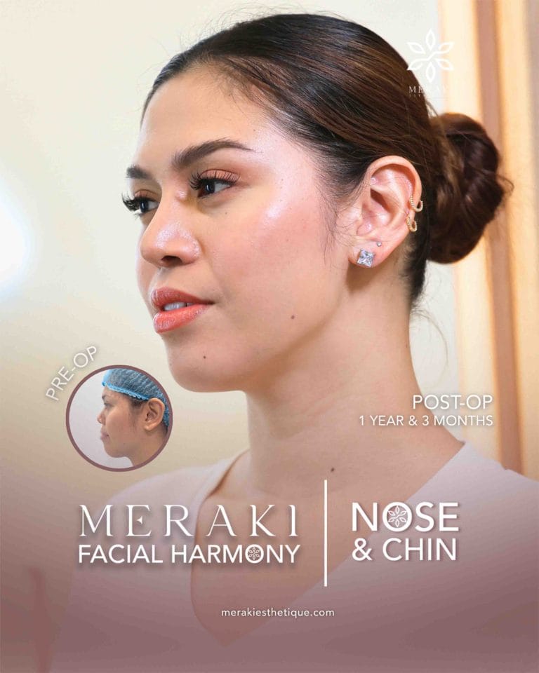 Trusted Rhinoplasty in Philippines