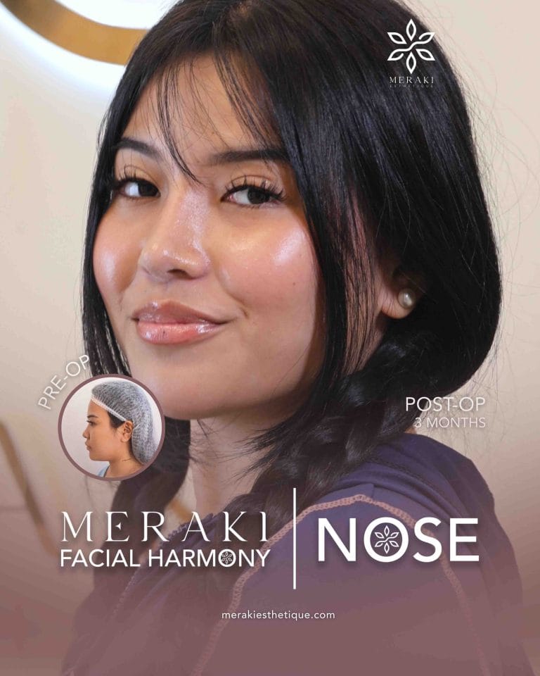 Trusted Rhinoplasty in Philippines