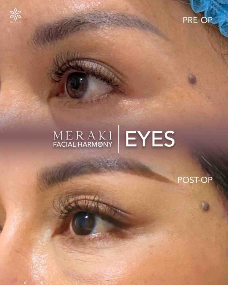 Meraki Eyes ( Best Temporal Lift in Philippines )