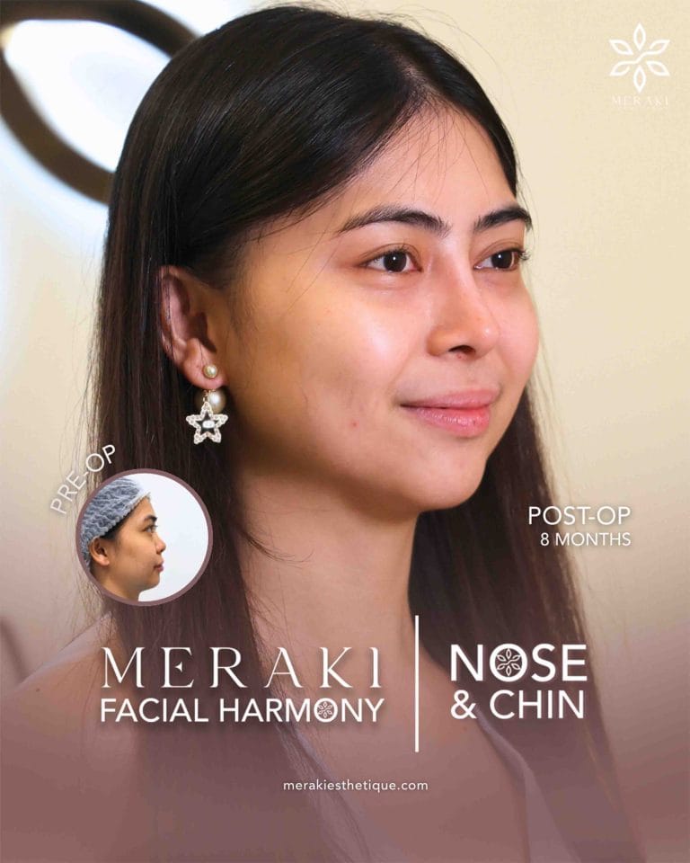 Trusted Rhinoplasty in Philippines