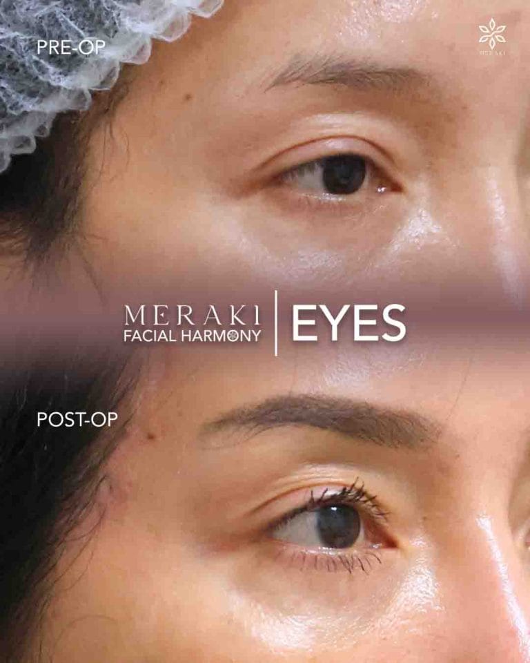 Meraki Eyes ( Best Temporal Lift in Philippines )