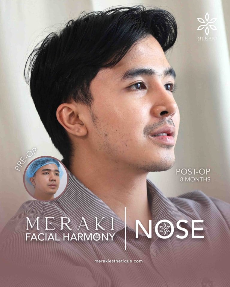 Best Rhinoplasty in Philippines