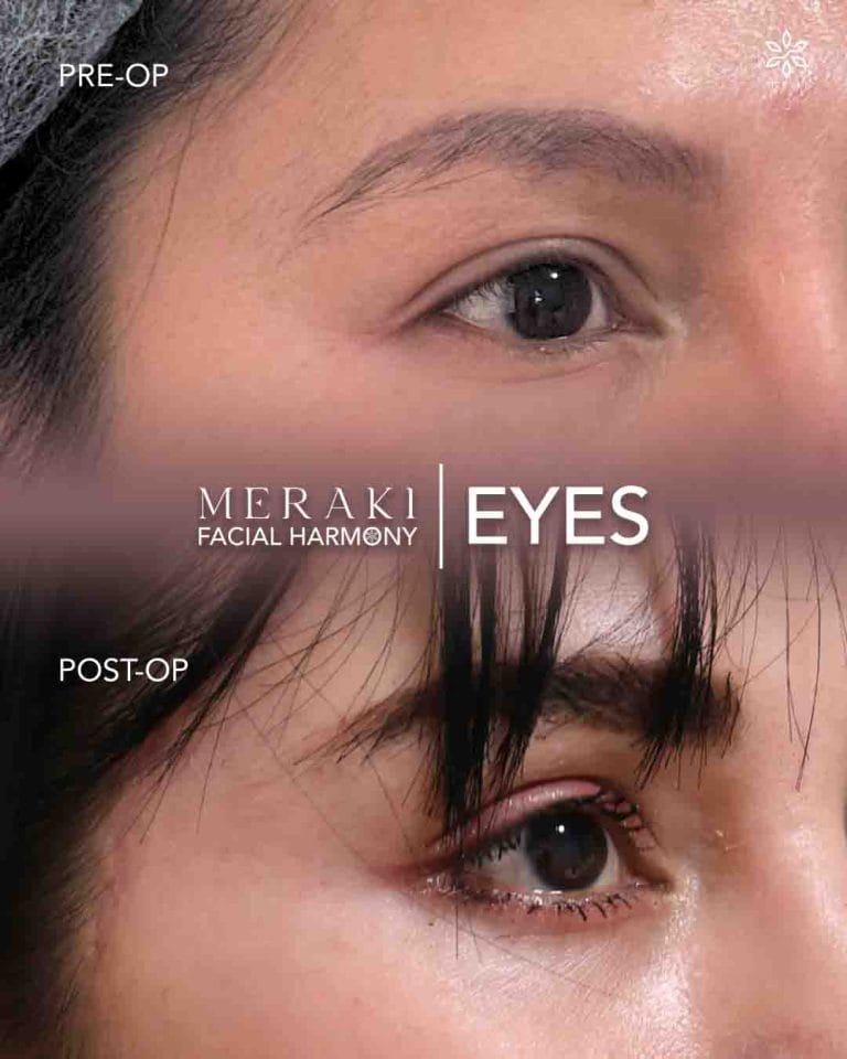 Meraki Eyes ( Best Temporal Lift in Philippines )