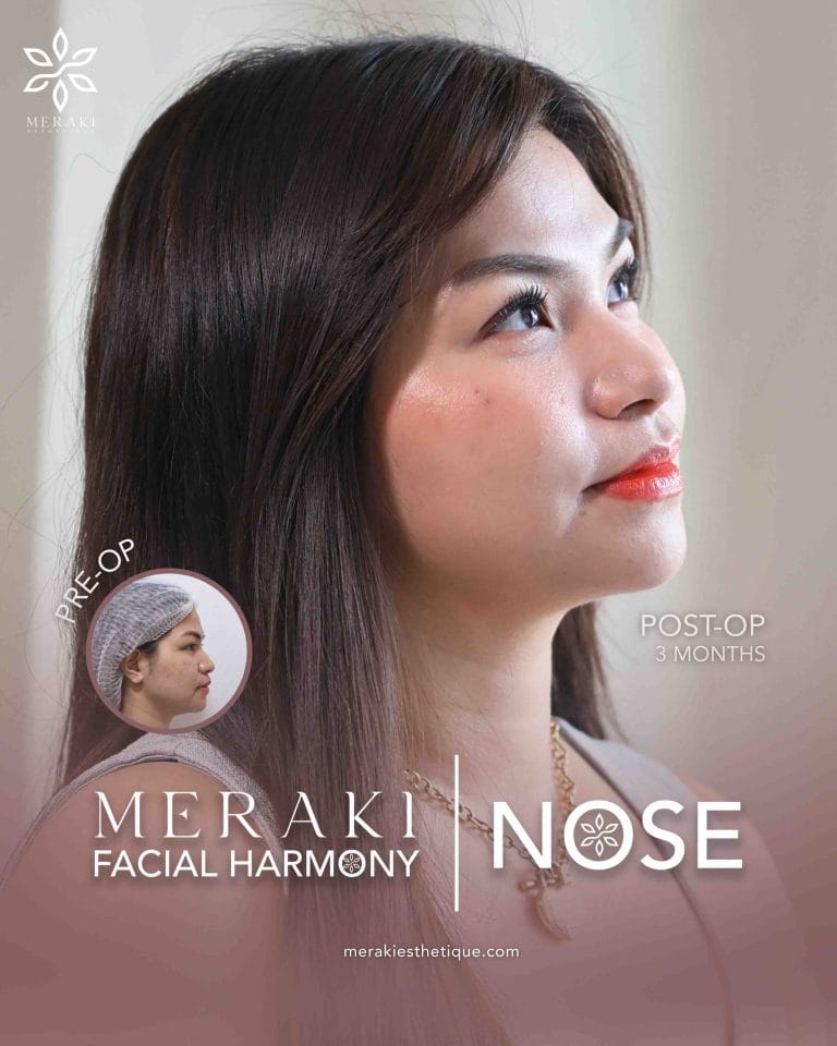 Best Rhinoplasty in Philippines