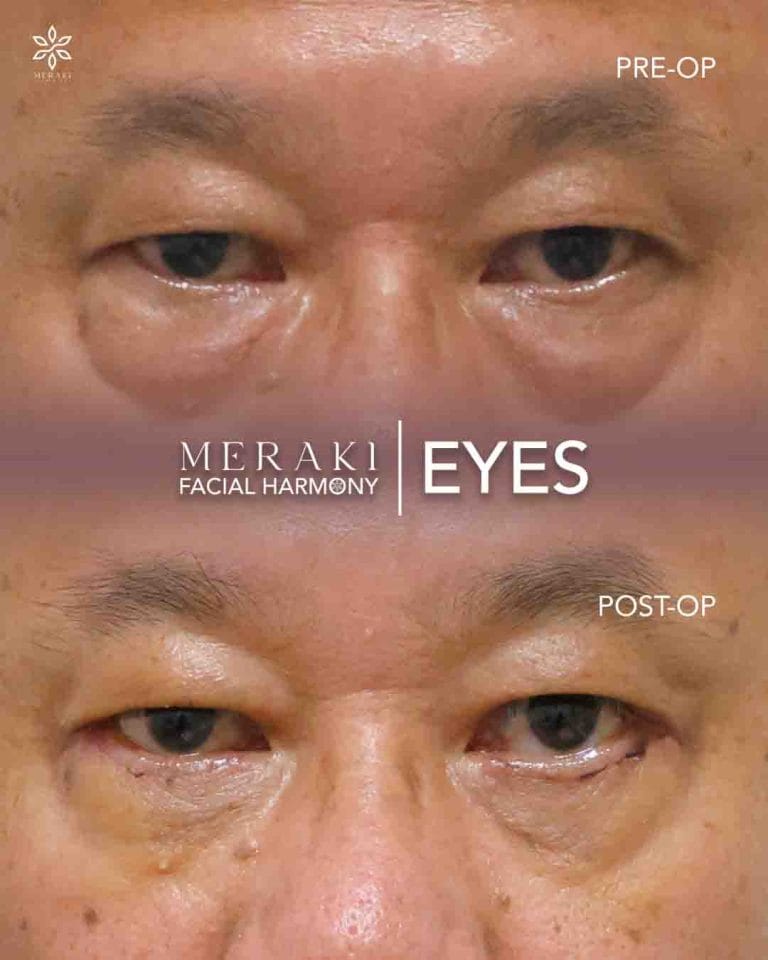 Meraki Eyes ( Best Temporal Lift in Philippines )