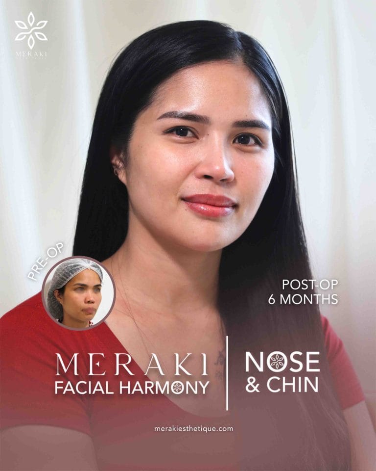 Best Rhinoplasty in Philippines