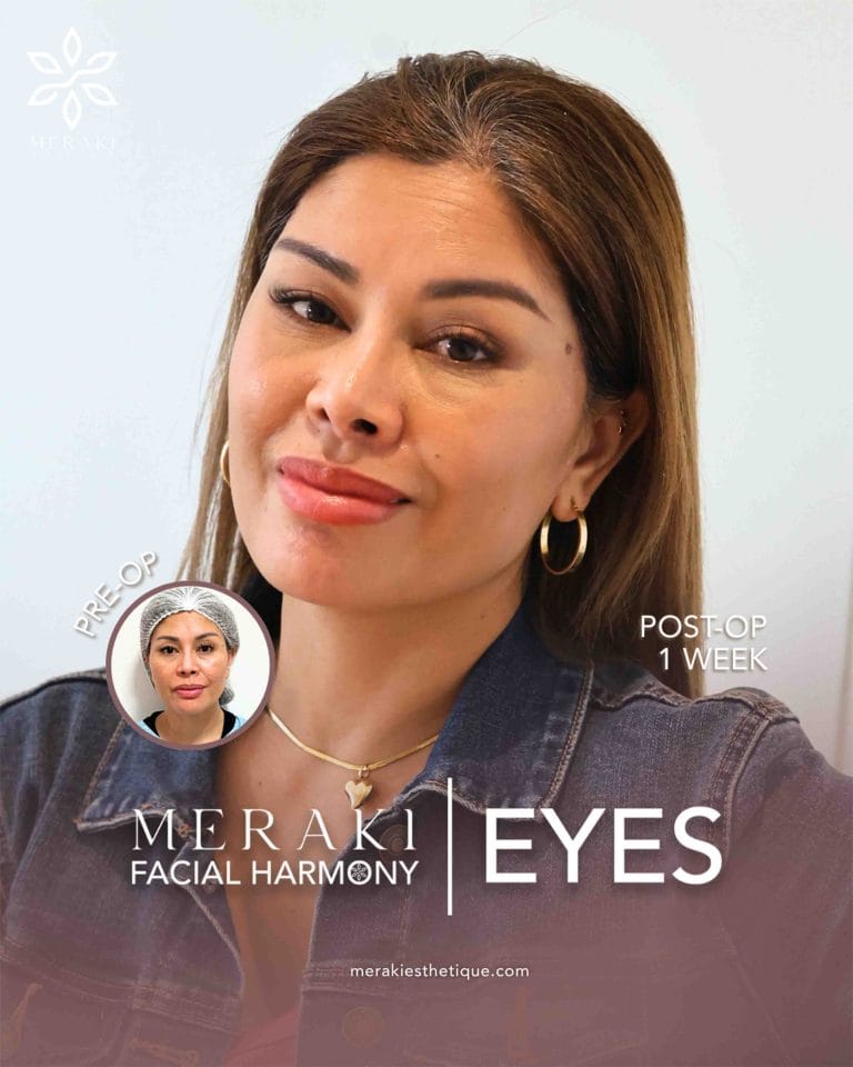 Best Rhinoplasty in Philippines