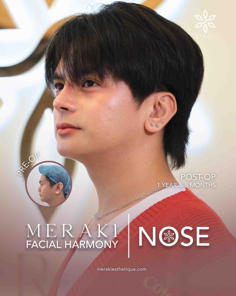 Best Rhinoplasty in Philippines