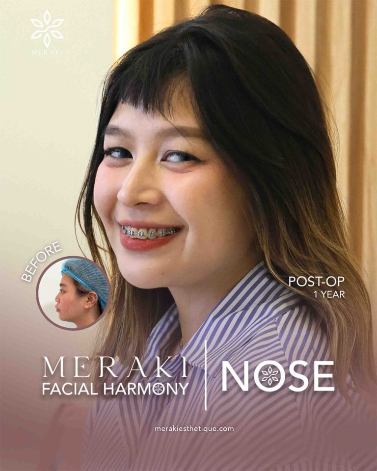 Trusted Rhinoplasty in Philippines